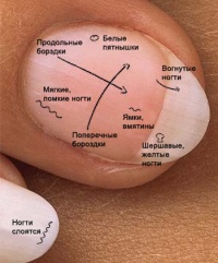 Определяем заболевания по ногтям 