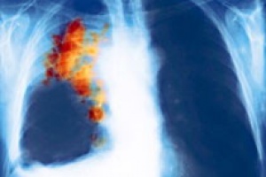 Ученые растолковали связь меж курением и раком легких