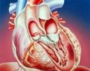 Имплантат понизит риск инфаркта при аритмии