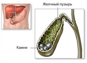 Активный стиль жизни понижает риск образования камешков в желчном пузыре на 70%