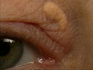 Желтоватые бляшки вокруг глаз предупреждают об инфаркте