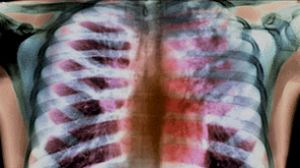 Английские ученые предлагают новейшую диагностику туберкулеза