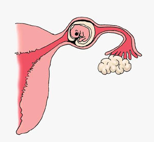 Внематочная беременность: последствия