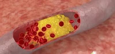 трудности при завышенном холестерине