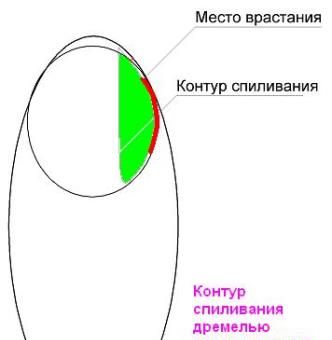 схема лечения вросшего ногтя