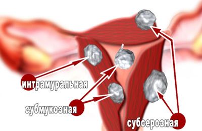 бывает различная миома