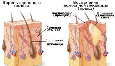 Внимание! Прыщи на голове нередко приводят к выпадению волос